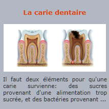 La carie dentaire