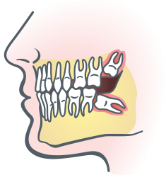 Extraction dents sagesse